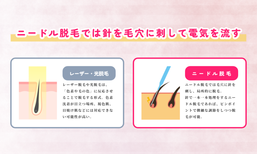 ニードル脱毛のご説明。針を毛穴に刺して電気を流して局所的に脱毛。ピンポイントで微細な調節をしつつ脱毛が可能です。