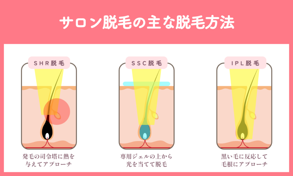 サロン脱毛の主な脱毛方法 SHR脱毛 SSC脱毛 IPL脱毛