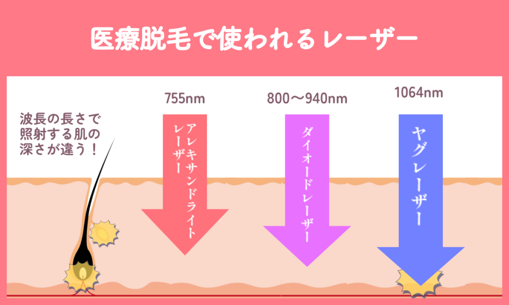 医療脱毛で使われるレーザーはアレキサンドライトレーザー、ダイオードレーザー、ヤグレーザーで波長の長さで照射する肌の深さが異なります。