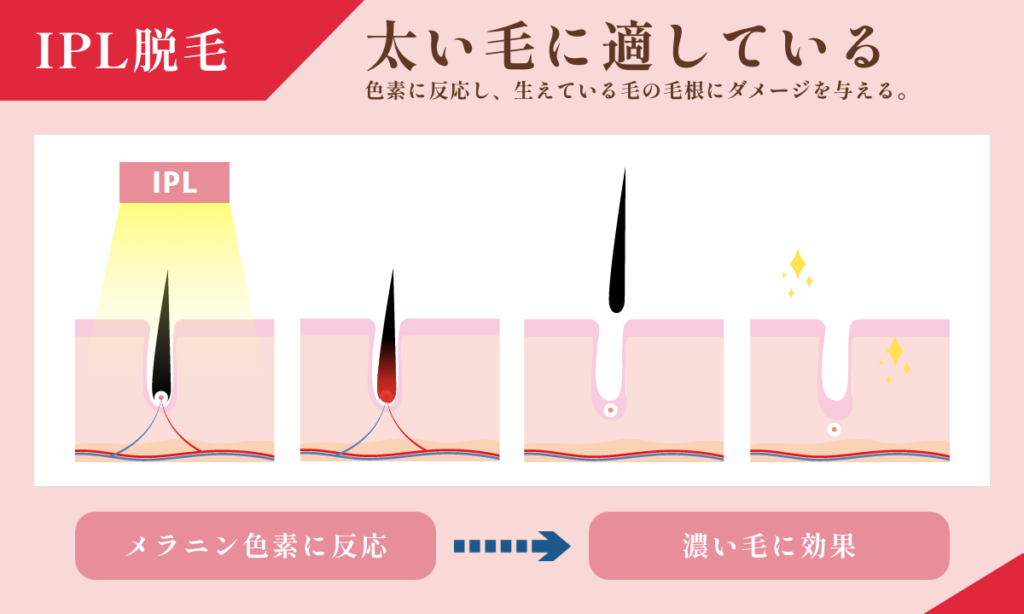 IPL脱毛の特徴は太い毛に適しているところです。色素に反応し、生えている毛の毛根にダメージを与えます。
