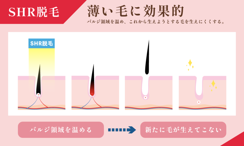 SHR脱毛は薄い毛に効果的です。バルジ領域を温め、これから生えようとする毛を生えにくくします。