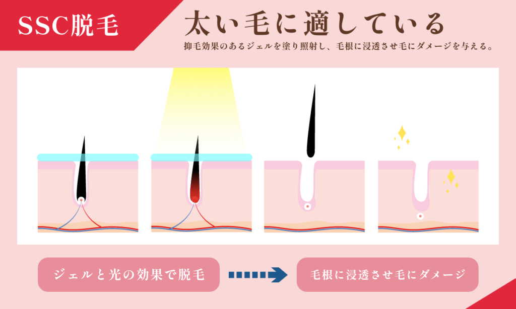 SSC脱毛は太い毛に適しています。抑毛効果のあるジェルを塗り照射し、毛根に浸透させ毛にダメージを与える。