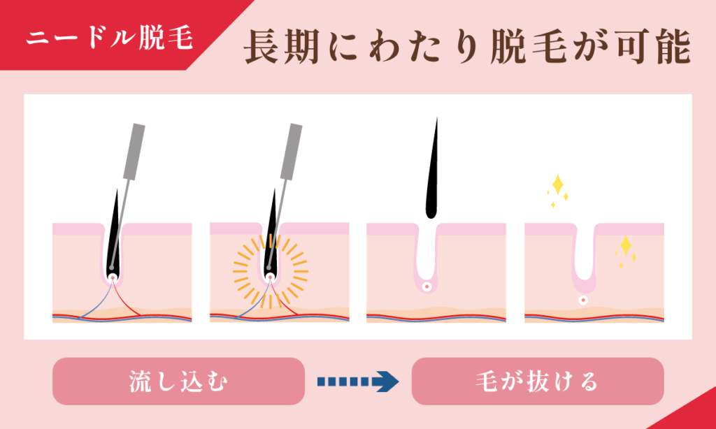 ニードル脱毛は長期にわたり脱毛が可能です。